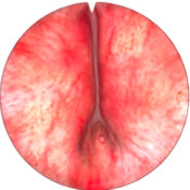 TURPSim - Simulateur de Résection Trans-Urétrale de Prostate